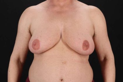FTM Chest Contouring Before & After Patient #2061