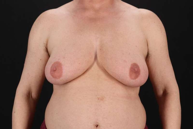 FTM Chest Contouring Before & After Patient #2061