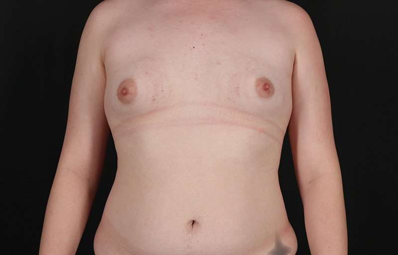 FTM Chest Contouring Before & After Patient #2072