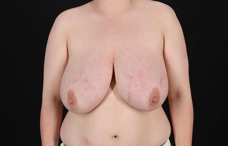 FTM Chest Contouring Before & After Patient #2083
