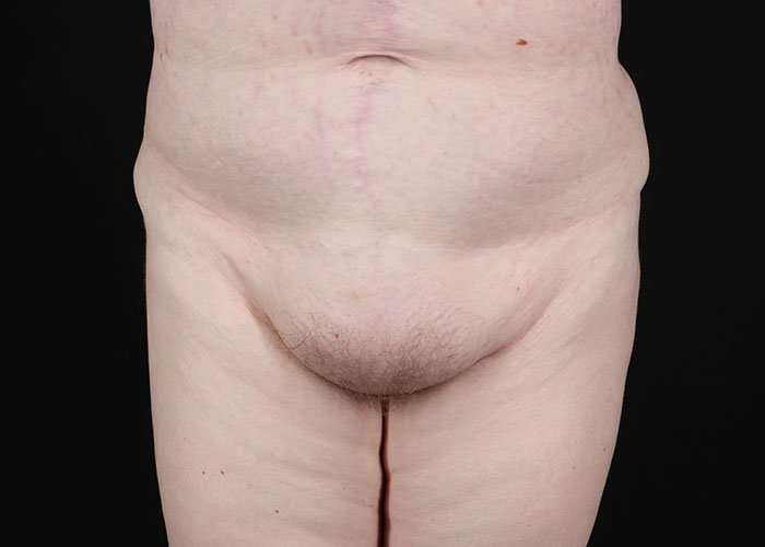 Monsplasty Before & After Patient #2106