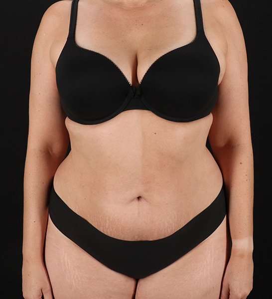Tummy Tuck Before & After Patient #2128