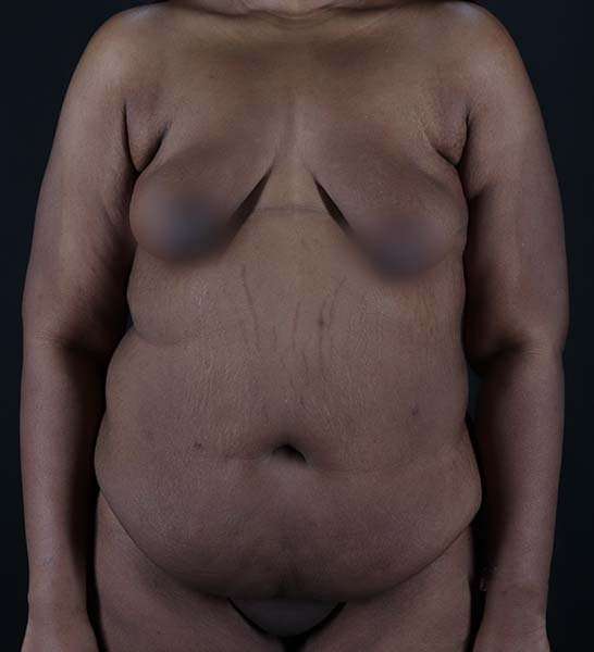 Tummy Tuck Before & After Patient #2139