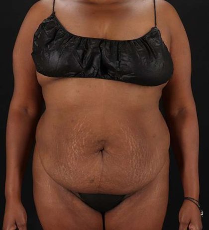 Tummy Tuck Before & After Patient #2146