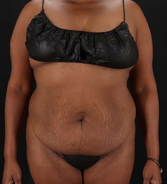 Tummy Tuck Before & After Patient #2146