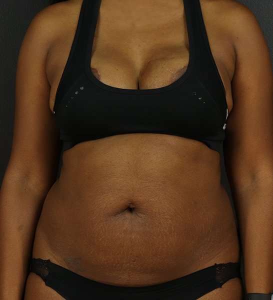 Tummy Tuck Before & After Patient #2168