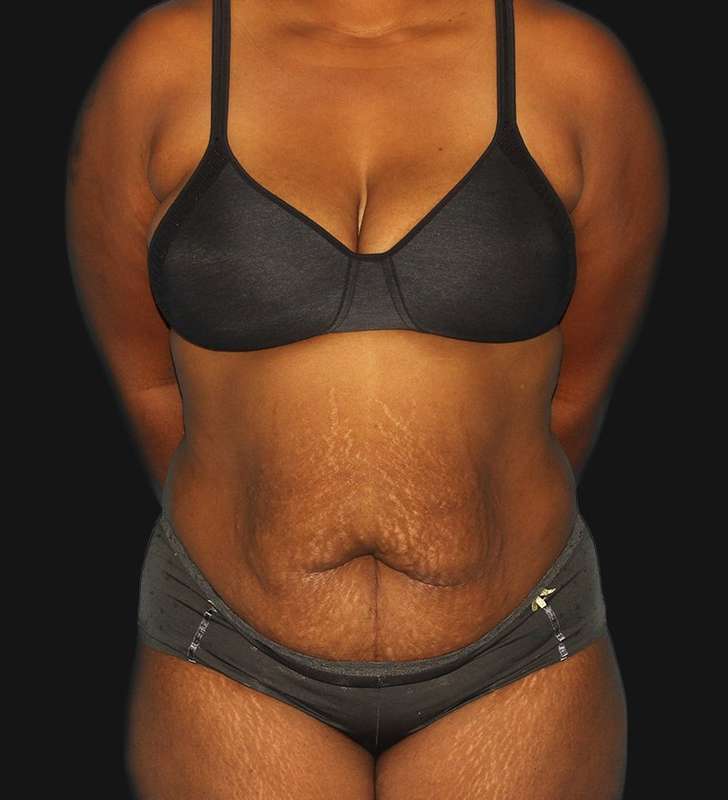 Tummy Tuck Before & After Patient #2179