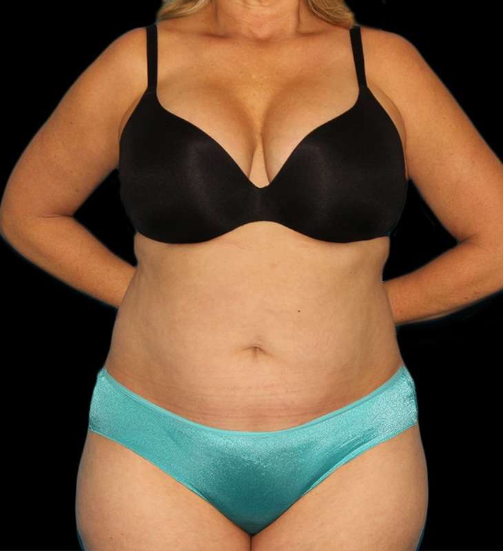 Tummy Tuck Before & After Patient #2190
