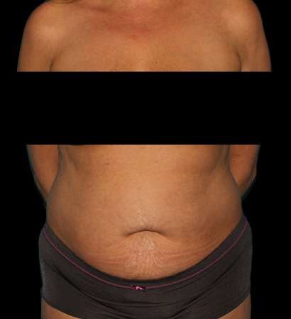 Tummy Tuck Before & After Patient #2201