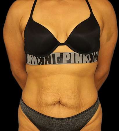 Tummy Tuck Before & After Patient #2212