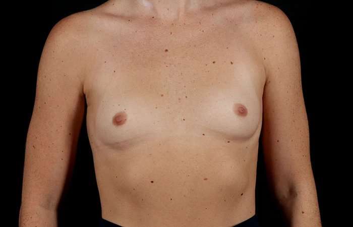 Breast Augmentation - Implant Before & After Patient #1012