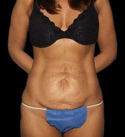 Tummy Tuck Before & After Patient #2269