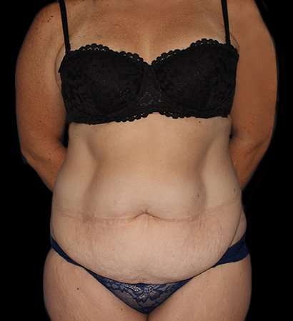 Tummy Tuck Before & After Patient #2280