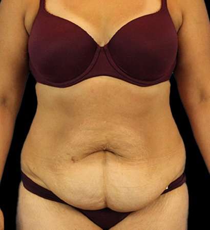 Tummy Tuck Before & After Patient #2291