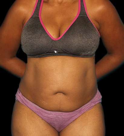 Tummy Tuck Before & After Patient #2302