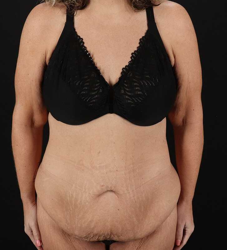 Tummy Tuck Before & After Patient #2326