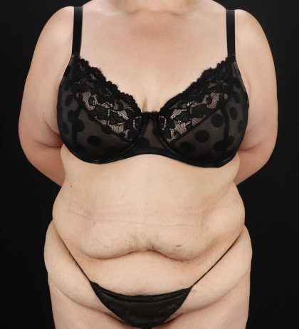 Tummy Tuck Before & After Patient #2339