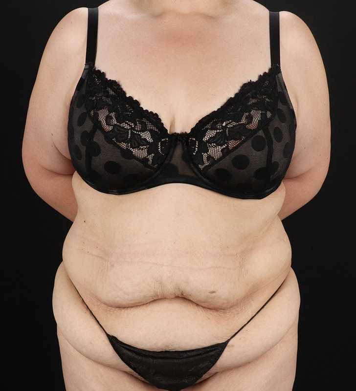 Tummy Tuck Before & After Patient #2339