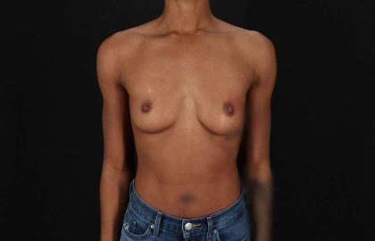 Breast Augmentation - Implant Before & After Patient #1023