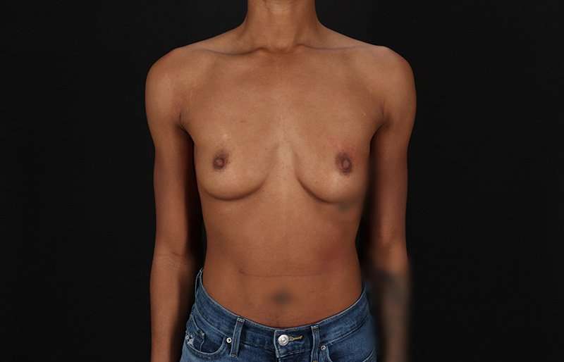 Breast Augmentation - Implant Before & After Patient #1023