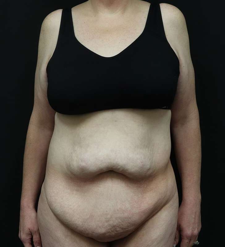 Tummy Tuck Before & After Patient #2363