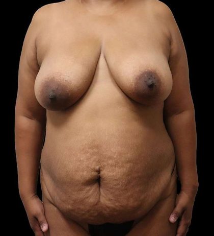 Tummy Tuck Before & After Patient #2389