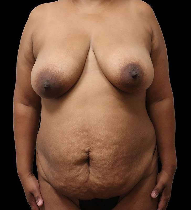 Tummy Tuck Before & After Patient #2389