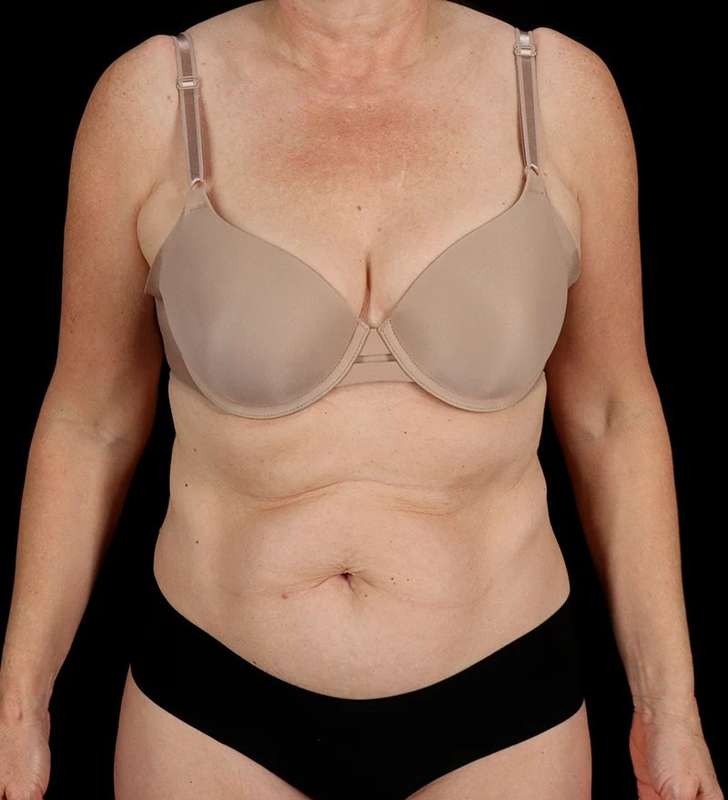 Tummy Tuck Before & After Patient #2435