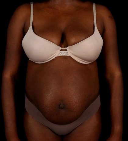 Tummy Tuck Before & After Patient #2448