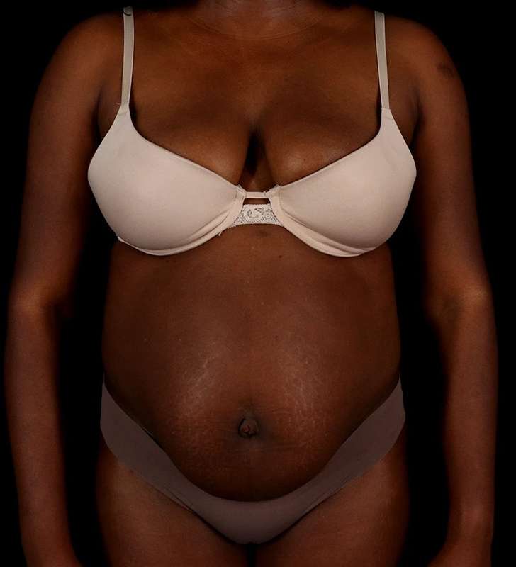 Tummy Tuck Before & After Patient #2448
