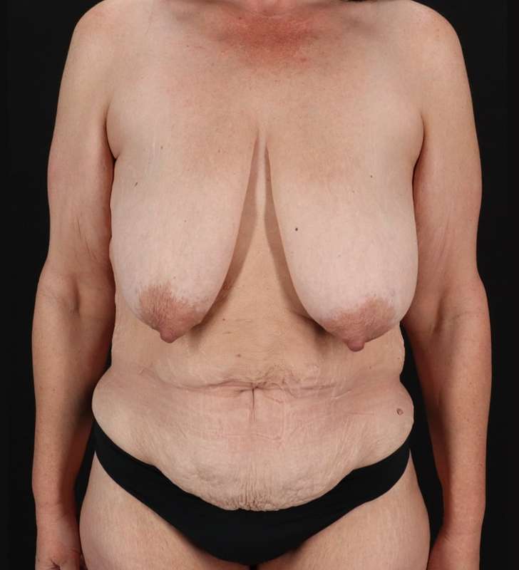 Tummy Tuck Before & After Patient #2461