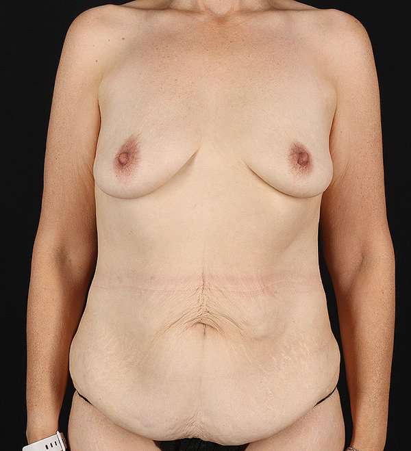Tummy Tuck Before & After Patient #2474