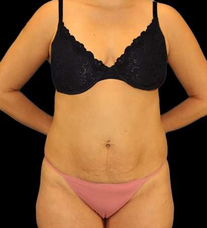 Tummy Tuck Before & After Patient #2485