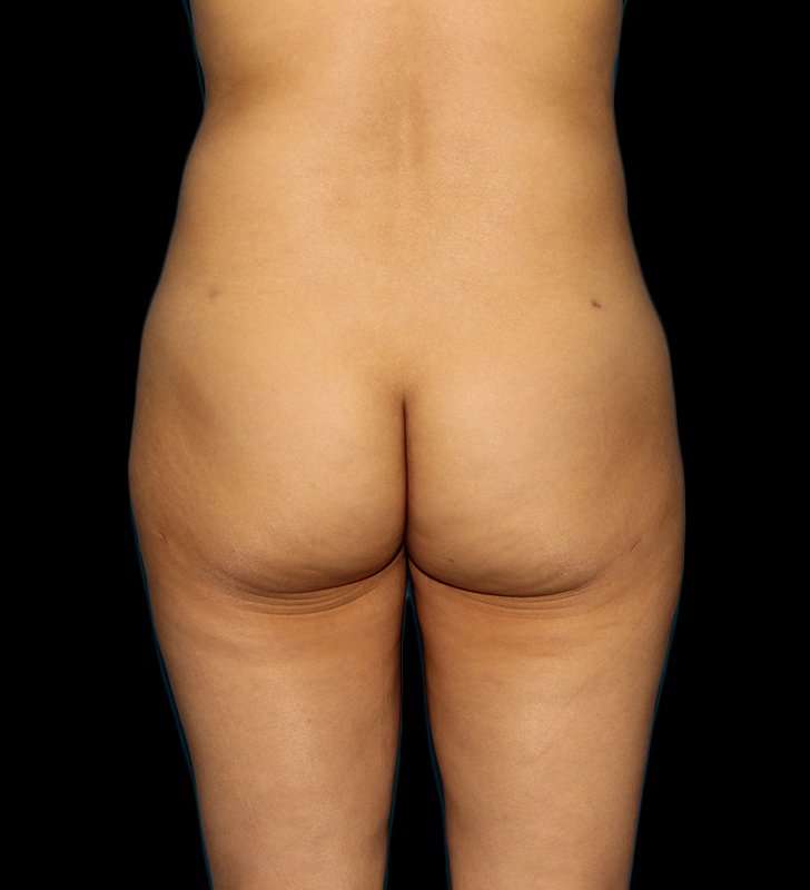 Brazilian Butt Lift Before & After Patient #2496