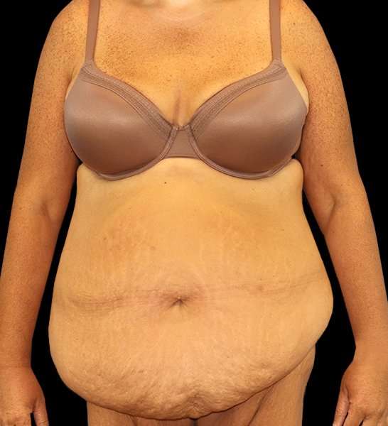 Circumferential Body Lift Before & After Patient #2509