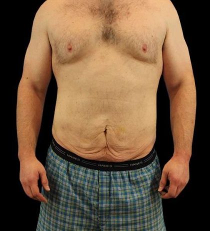 Circumferential Body Lift Before & After Patient #2522