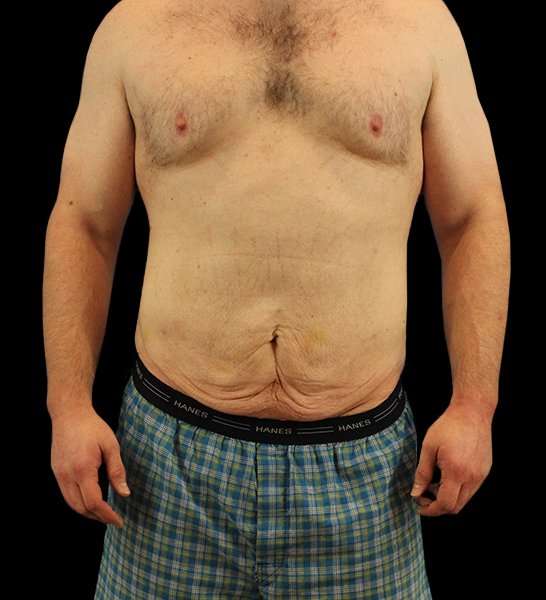 Circumferential Body Lift Before & After Patient #2522