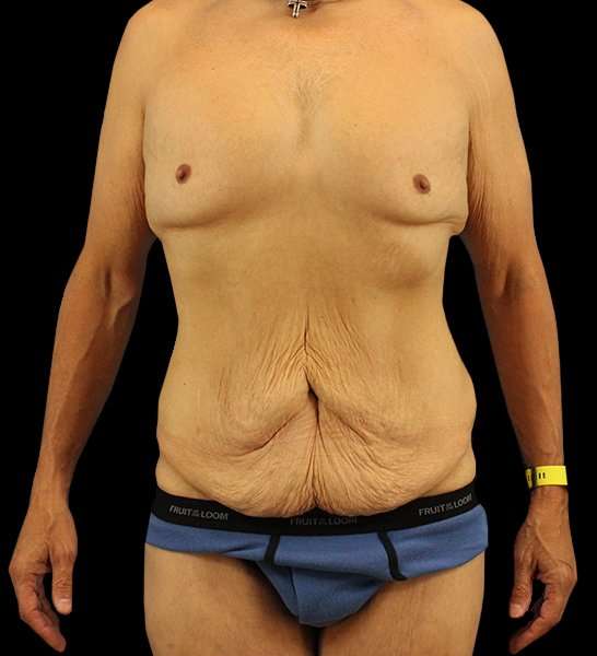 Circumferential Body Lift Before & After Patient #2535