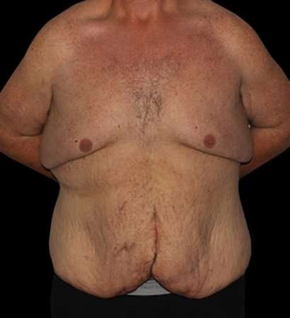 Massive Weight Loss Before & After Patient #5155