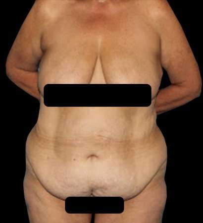 Circumferential Body Lift Before & After Patient #2572