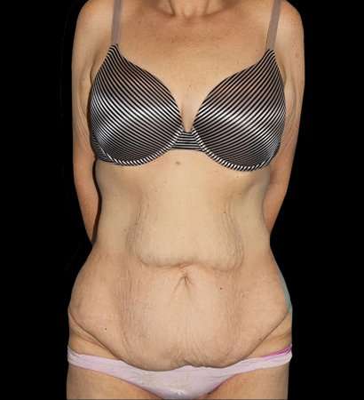 Circumferential Body Lift Before & After Patient #2598