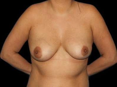 Breast Augmentation - Implant Before & After Patient #1043