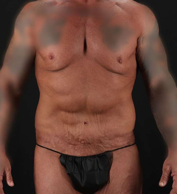 Circumferential Body Lift Before & After Patient #2611