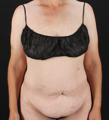 Circumferential Body Lift Before & After Patient #2624