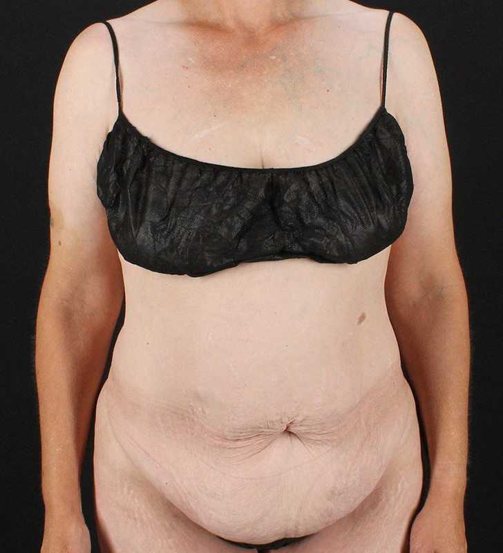 Circumferential Body Lift Before & After Patient #2624