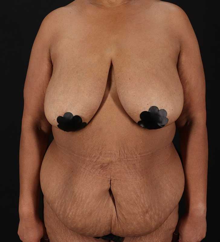 Circumferential Body Lift Before & After Patient #2637