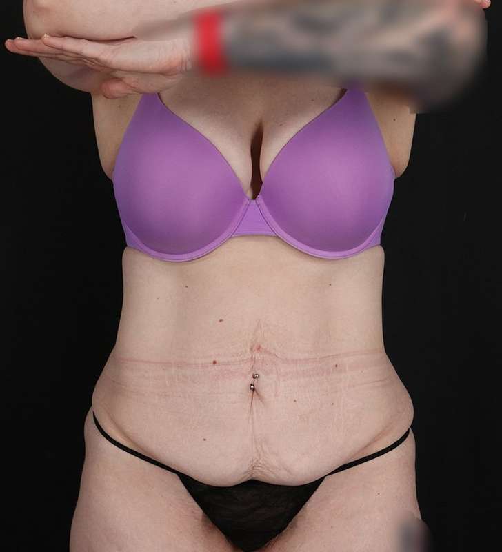 Circumferential Body Lift Before & After Patient #2650