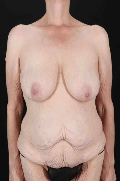 Circumferential Body Lift Before & After Patient #2663