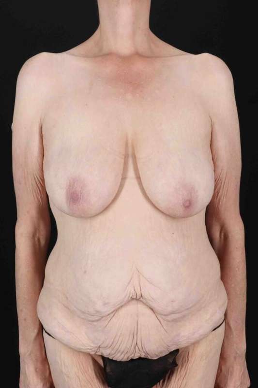 Circumferential Body Lift Before & After Patient #2663