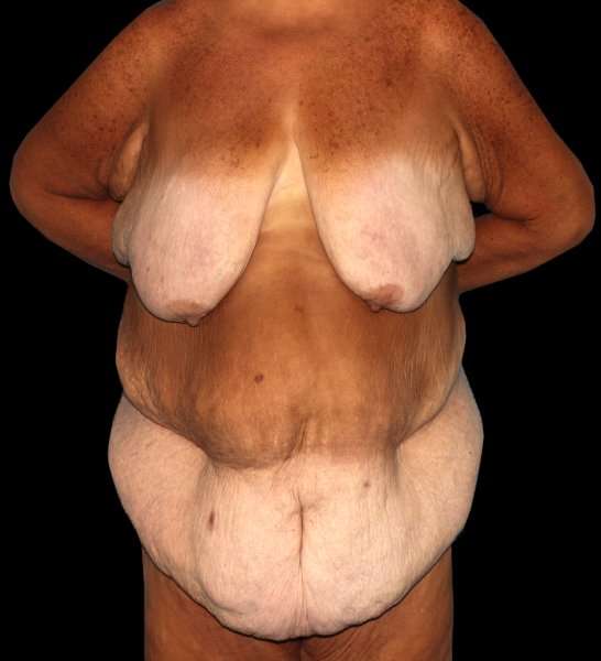 Fleur De Lis Circumferential Body Lift Before & After Patient #2674